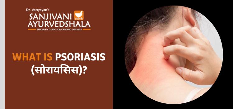 WHAT IS PSORIASIS (सोरायसिस)?
