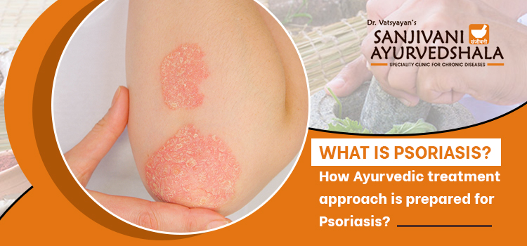 What is psoriasis? How Ayurvedic treatment approach is prepared for Psoriasis?