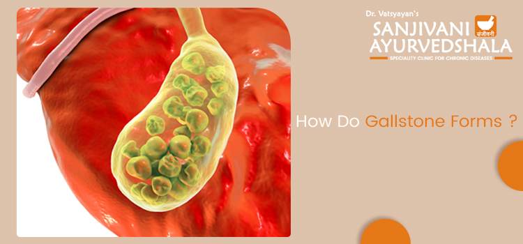 What are gallstones? How are gallstones formed in the body?