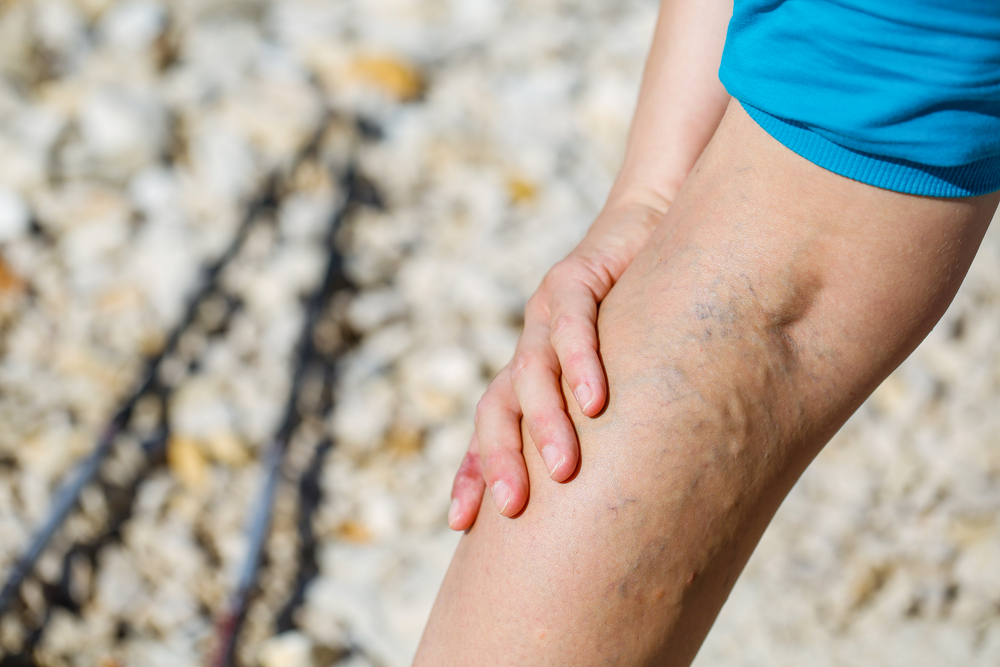 What-are-varicose-veins-and-how-can-it-be-cured-with-help-of-Ayurveda?